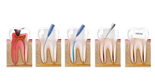 Endodontie