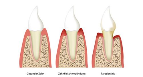 Parodontitisbehandlung